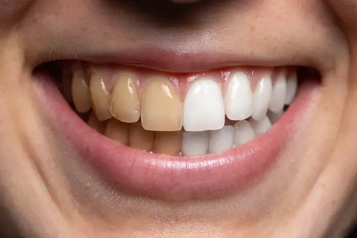 Teeth before and after whitening.